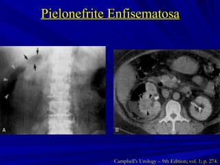 Pielonefrite Enfisematosa Campbell’s Urology – 9th Edition; vol. 1; p. 274. 