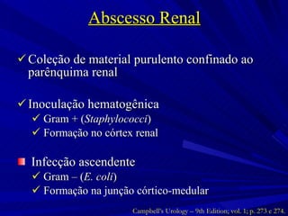 Abscesso Renal Coleção de material purulento confinado ao parênquima renal Inoculação hematogênica Gram + ( Staphylococci ) Formação no córtex renal  Infecção ascendente Gram – ( E. coli ) Formação na junção córtico-medular Campbell’s Urology – 9th Edition; vol. 1; p. 273 e 274. 