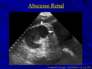 Abscesso Renal Campbell’s Urology – 9th Edition; vol. 1; p. 275. 