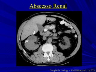 Abscesso Renal Campbell’s Urology – 9th Edition; vol. 1; p. 275. 