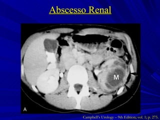 Abscesso Renal Campbell’s Urology – 9th Edition; vol. 1; p. 275. 