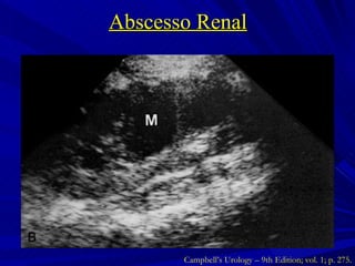 Abscesso Renal Campbell’s Urology – 9th Edition; vol. 1; p. 275. 
