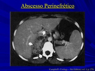 Abscesso Perinefrético Campbell’s Urology – 9th Edition; vol. 1; p. 278. 