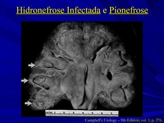 Hidronefrose Infectada  e  Pionefrose Campbell’s Urology – 9th Edition; vol. 1; p. 276. 