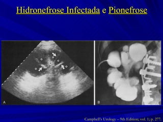 Hidronefrose Infectada  e  Pionefrose Campbell’s Urology – 9th Edition; vol. 1; p. 277. 