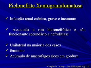 Pielonefrite Xantogranulomatosa Infecção renal crônica, grave e incomum Associada a rim hidronefrótico e não funcionante secundário a nefrolitíase Unilateral na maioria dos casos feminino Acúmulo de macrófagos ricos em gordura Campbell’s Urology – 9th Edition; vol. 1; p. 281. 