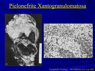 Pielonefrite Xantogranulomatosa Campbell’s Urology – 9th Edition; vol. 1; p. 282. 
