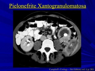 Pielonefrite Xantogranulomatosa Campbell’s Urology – 9th Edition; vol. 1; p. 283. 
