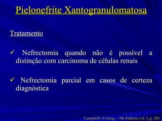 Pielonefrite Xantogranulomatosa Tratamento Nefrectomia quando não é possível a distinção com carcinoma de células renais Nefrectomia parcial em casos de certeza diagnóstica Campbell’s Urology – 9th Edition; vol. 1; p. 283. 