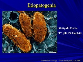Etiopatogenia pili tipo1: Cistite “ P” pili: Pielonefrite Campbell’s Urology – 9th Edition; vol. 1; p. 230. 