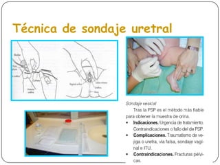 LOCALIZAR EL SITIO DE INFECCION(PIELONEFRITIS vs CISTITIS).