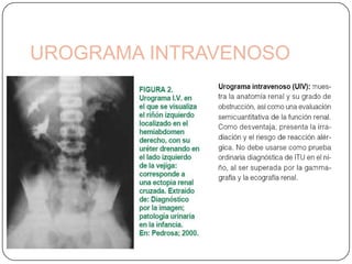 Urocultivo:Fundamental en ITUSi el niño esta febril o luce tóxico tomarlo (el médico ) por PSP o sonda, inmediatamenteSi los padres no permiten, tratar en la mitad de la micciónEs la pirámide del diagnóstico correcto ITUSembrarlo inmediatamente 