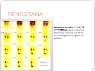 Recomendaciones de Evaluación Imagenológica  en ITUNiños menores de dos añosNiños con pielonefritisBacteriuria en menores de 1 añoHipertensiónMasa abdominalAnomalías posteriores de la línea mediaHidronefrosis prenatal