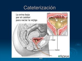 Cateterización
AMC
 