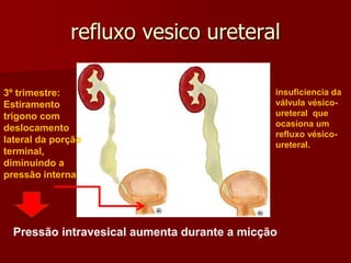 refluxo vesico ureteral
insuficiencia da
válvula vésico-
ureteral que
ocasiona um
refluxo vésico-
ureteral.
3º trimestre:
Estiramento
trígono com
deslocamento
lateral da porção
terminal,
diminuindo a
pressão interna
Pressão intravesical aumenta durante a micção
 