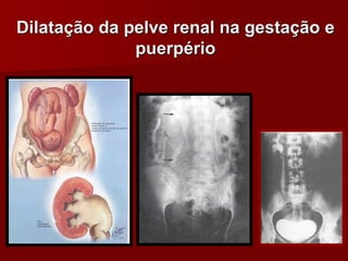 Dilatação da pelve renal na gestação e
puerpério
 