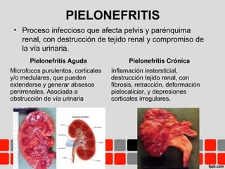 PIELONEFRITIS
• Proceso infeccioso que afecta pelvis y parénquima
renal, con destrucción de tejido renal y compromiso de
la vía urinaria.
Pielonefritis Aguda Pielonefritis Crónica
Microfocos purulentos, corticales
y/o medulares, que pueden
extenderse y generar absesos
perirrenales. Asociada a
obstrucción de vía urinaria
Inflamación instersticial,
destrucción tejido renal, con
fibrosis, retracción, deformación
pielocaliciar, y depresiones
corticales irregulares.
 
