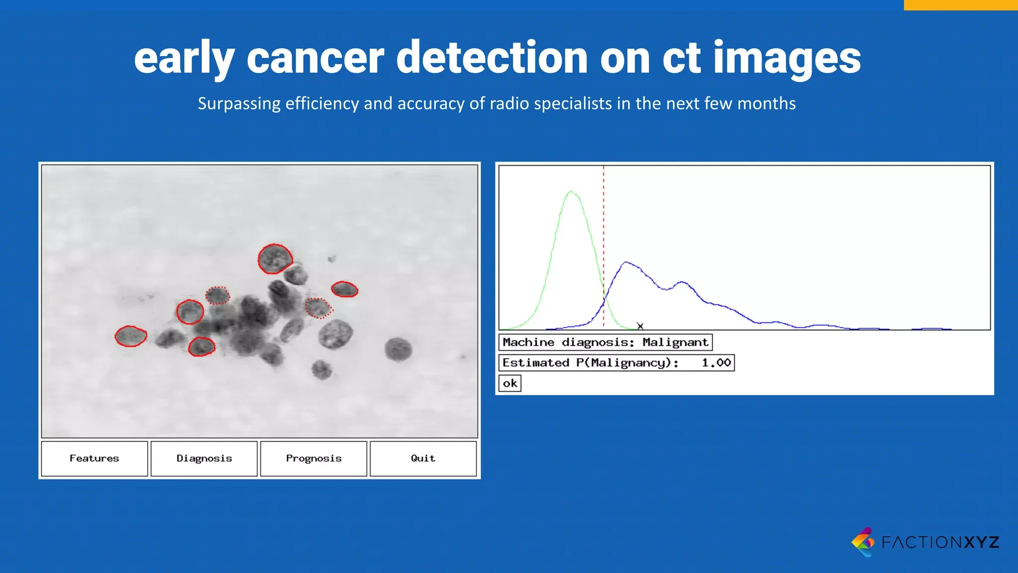 early cancer detection on ct images
Surpassing	efficiency	and	accuracy	of	radio	specialists	in	the	next	few	months
 
