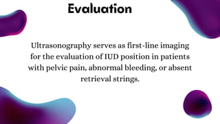 Evaluation
Ultrasonography serves as first-line imaging
for the evaluation of IUD position in patients
with pelvic pain, abnormal bleeding, or absent
retrieval strings.
 