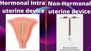 Hormonal Intra
uterine device
Non-Hormonal
uterine device
 