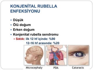 KONJENİTAL RUBELLA
ENFEKSİYONU
 Düşük
 Ölü doğum
 Erken doğum
 Konjenital rubella sendromu
 Sıklık: ilk 12 hf içinde: %90
12-16 hf arasında: %20
 