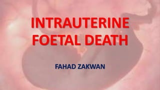INTRAUTERINE
FOETAL DEATH
FAHAD ZAKWAN
 
