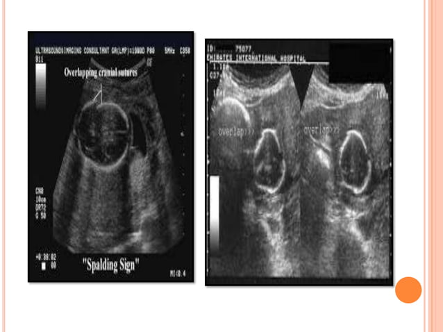 IUFD(INTRA UTERINE FETAL DEATH).pptx | Pregnancy | Reproductive Health