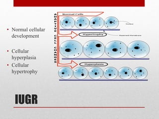IUGR
• Normal cellular
development
• Cellular
hyperplasia
• Cellular
hypertrophy
 