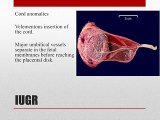 IUGR
Cord anomalies
Velementous insertion of
the cord.
Major umbilical vessels
separate in the fetal
membranes before reaching
the placental disk.
 