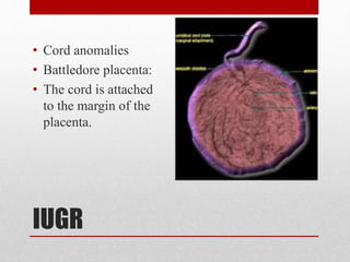 IUGR
• Cord anomalies
• Battledore placenta:
• The cord is attached
to the margin of the
placenta.
 
