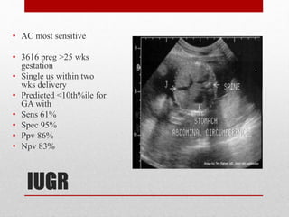 IUGR
• AC most sensitive
• 3616 preg >25 wks
gestation
• Single us within two
wks delivery
• Predicted <10th%ile for
GA with
• Sens 61%
• Spec 95%
• Ppv 86%
• Npv 83%
 
