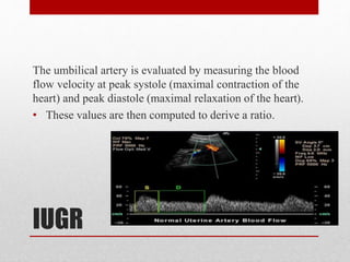 IUGR
The umbilical artery is evaluated by measuring the blood
flow velocity at peak systole (maximal contraction of the
heart) and peak diastole (maximal relaxation of the heart).
• These values are then computed to derive a ratio.
 