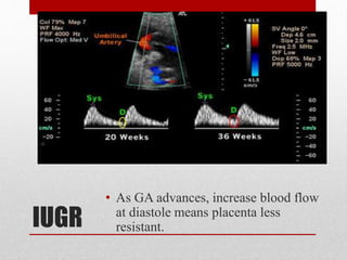 IUGR
• As GA advances, increase blood flow
at diastole means placenta less
resistant.
 