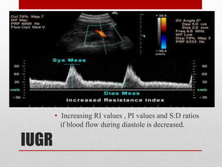 IUGR
• Increasing RI values , PI values and S:D ratios
if blood flow during diastole is decreased.
 