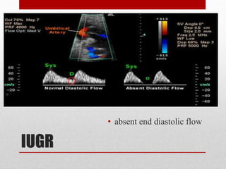 IUGR
• absent end diastolic flow
 