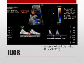 IUGR
• reversal of end diastolic
flow (REDF) :
 