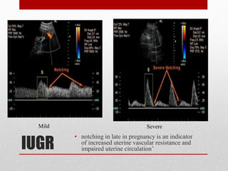 IUGR
• notching in late in pregnancy is an indicator
of increased uterine vascular resistance and
impaired uterine circulation’
Mild Severe
 
