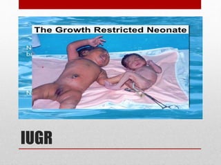 IUGR
 
