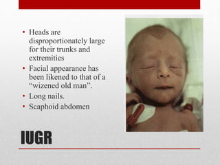 IUGR
• Heads are
disproportionately large
for their trunks and
extremities
• Facial appearance has
been likened to that of a
“wizened old man”.
• Long nails.
• Scaphoid abdomen
 