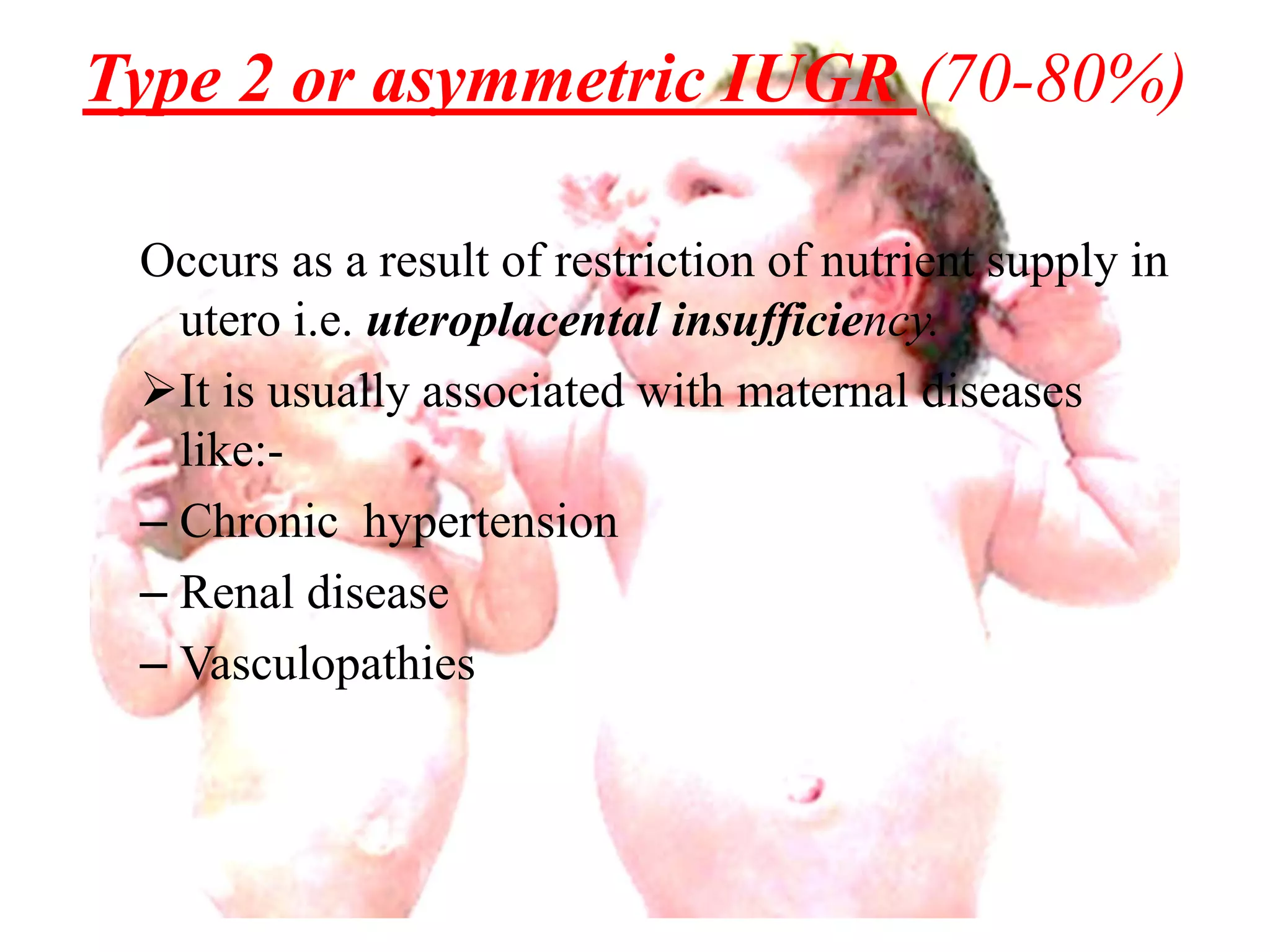 Type 2 or asymmetric IUGR (70-80%) 
Occurs as a result of restriction of nutrient supply in 
utero i.e. uteroplacental insufficiency. 
It is usually associated with maternal diseases 
like:- 
– Chronic hypertension 
– Renal disease 
– Vasculopathies 
 