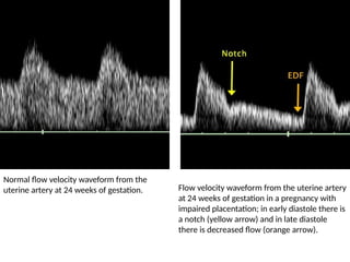 Normal flow velocity waveform from the
uterine artery at 24 weeks of gestation. Flow velocity waveform from the uterine artery
at 24 weeks of gestation in a pregnancy with
impaired placentation; in early diastole there is
a notch (yellow arrow) and in late diastole
there is decreased flow (orange arrow).
 