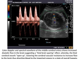 Color doppler and spectral waveform of the middle cerebral artery shows increased
diastolic flow in the brain suggesting a "fetal brain sparing" effect, whereby, the fetal
cerebral vessels "open up", lowering the cerebral vascular resistance to increase flow
to the brain thus diverting blood to the important organs in a state of overall hypoxia.
 