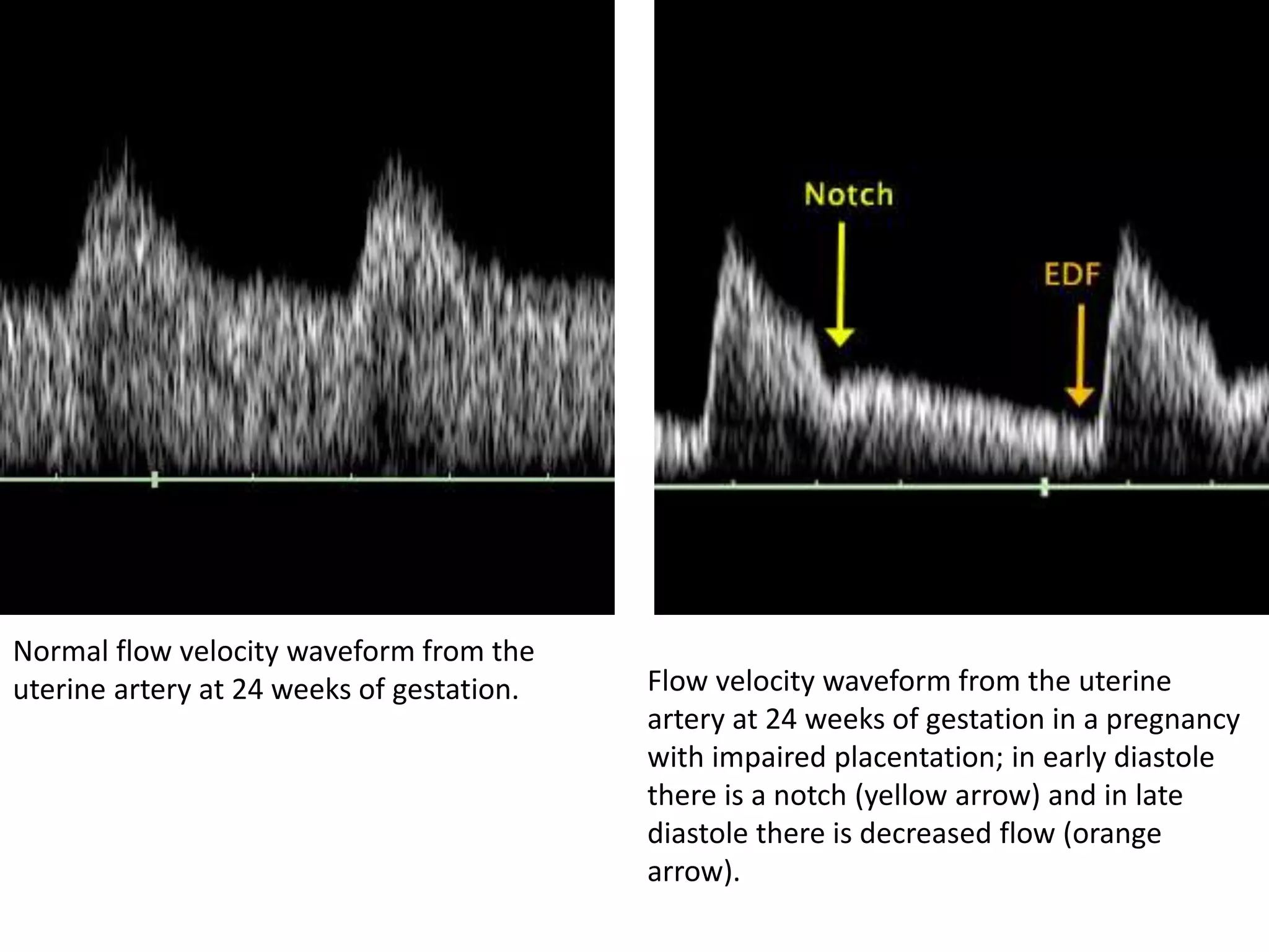 Normal flow velocity waveform from the
uterine artery at 24 weeks of gestation. Flow velocity waveform from the uterine
artery at 24 weeks of gestation in a pregnancy
with impaired placentation; in early diastole
there is a notch (yellow arrow) and in late
diastole there is decreased flow (orange
arrow).
 