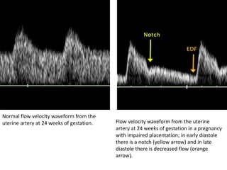 Normal flow velocity waveform from the
uterine artery at 24 weeks of gestation. Flow velocity waveform from the uterine
artery at 24 weeks of gestation in a pregnancy
with impaired placentation; in early diastole
there is a notch (yellow arrow) and in late
diastole there is decreased flow (orange
arrow).
 
