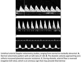 Umbilical arterial Doppler velocimetry studies, ranging from normal to markedly abnormal. A.
Normal velocimetry pattern with an S/D ratio of <30. B. The diastolic velocity approaching zero
reflects increased placental vascular resistance. C. During diastole, arterial flow is reversed
(negative S/D ratio), which is an ominous sign that may precede fetal demise
 