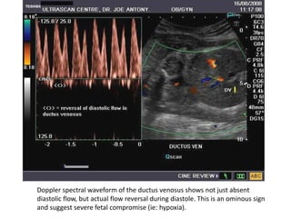 Doppler spectral waveform of the ductus venosus shows not just absent
diastolic flow, but actual flow reversal during diastole. This is an ominous sign
and suggest severe fetal compromise (ie: hypoxia).
 