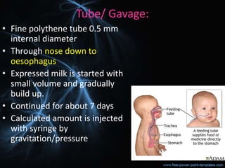 Tube/ Gavage:
• Fine polythene tube 0.5 mm
internal diameter
• Through nose down to
oesophagus
• Expressed milk is started with
small volume and gradually
build up.
• Continued for about 7 days
• Calculated amount is injected
with syringe by
gravitation/pressure
 
