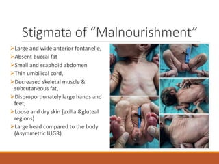 Stigmata of “Malnourishment”
Large and wide anterior fontanelle,
Absent buccal fat
Small and scaphoid abdomen
Thin umbilical cord,
Decreased skeletal muscle &
subcutaneous fat,
Disproportionately large hands and
feet,
Loose and dry skin (axilla &gluteal
regions)
Large head compared to the body
(Asymmetric IUGR)
 