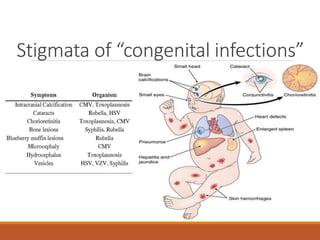 Stigmata of “congenital infections”
 