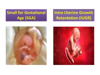 Small for Gestational
Age (SGA)
Intra Uterine Growth
Retardation (IUGR)
 